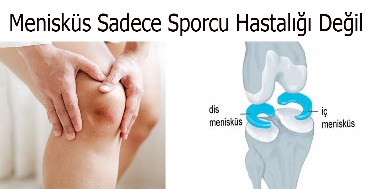 Menisküs Sadece Sporcu Hastalığı Değil