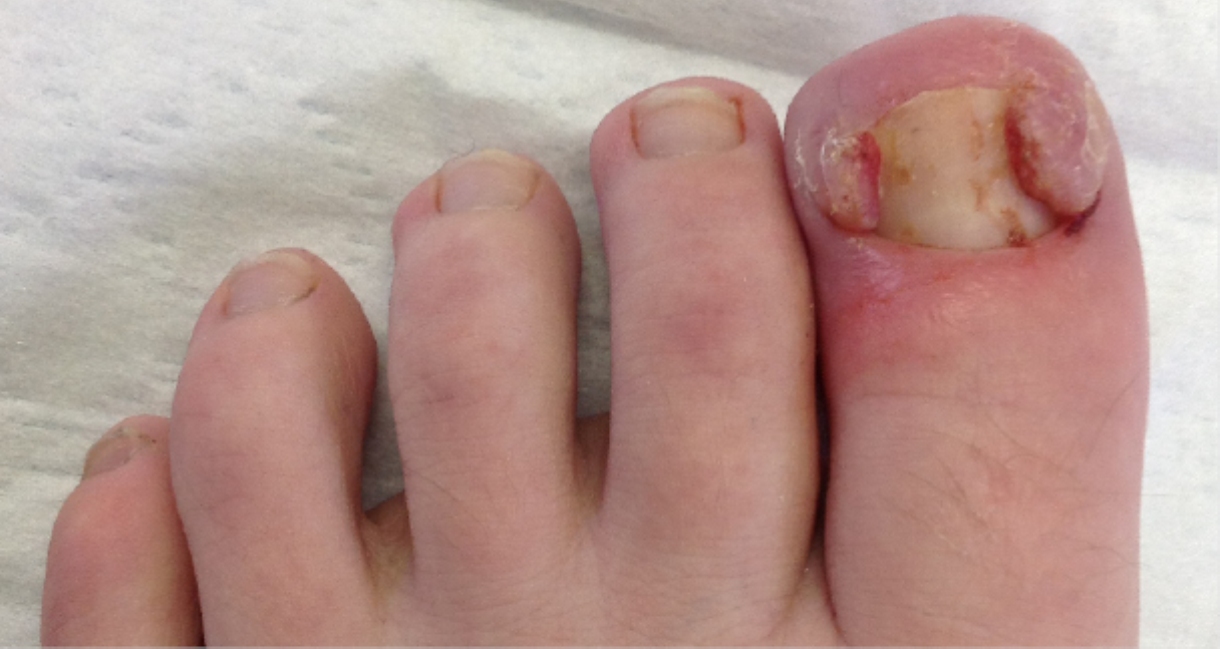 Tırnak Batmasına Dair Her şey