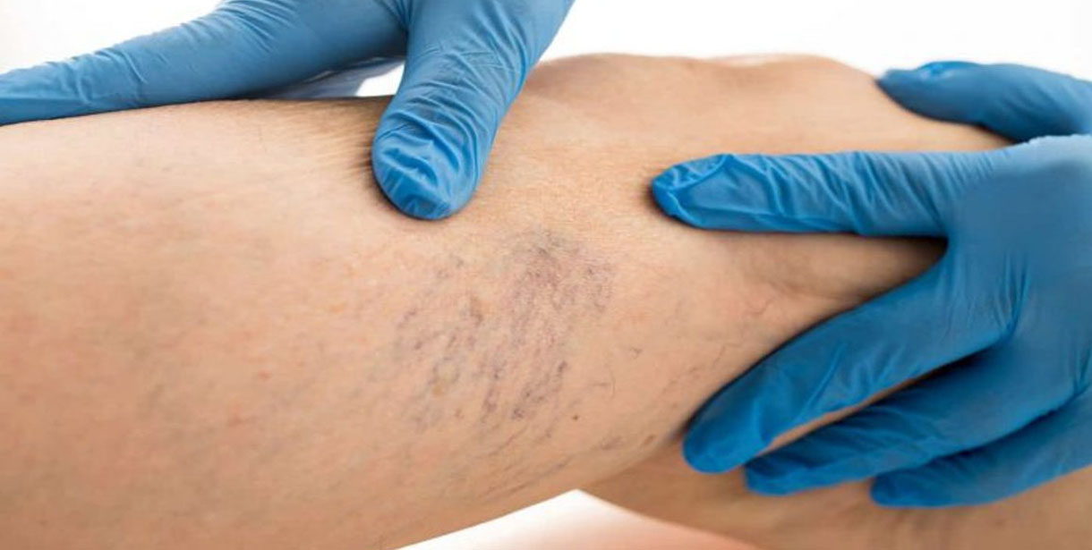 Varis hastalarına 10 önemli yaz önerisi