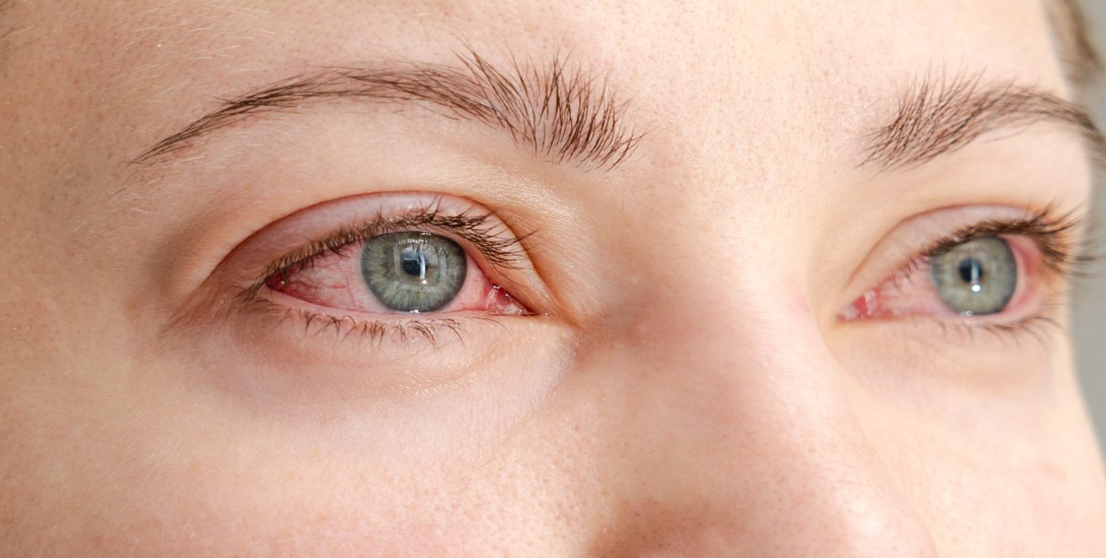 Türkiye'de ve Dünyada 50 Yaş Altı Körlüğün Birinci Nedeni, Diyabetik Retinopati