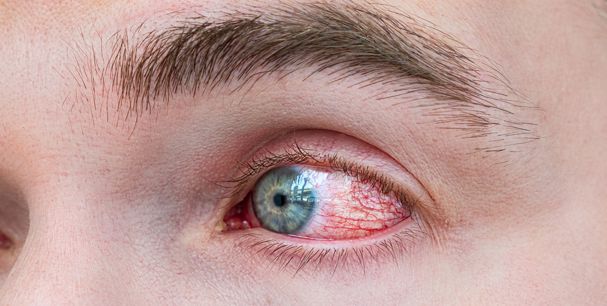 Göz Alerjisi Görme Kaybına Sebep Olabilir